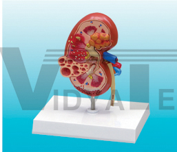 The dissection model of kidney and cyst